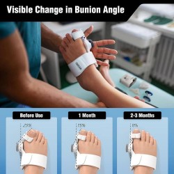 corrective splint for bunion